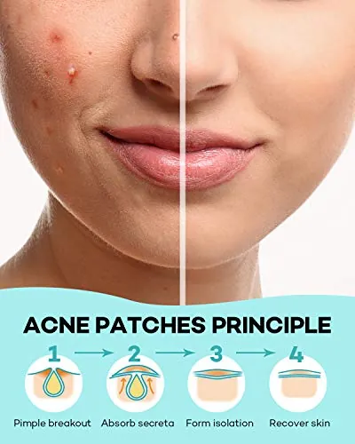 TKTK Pimple Patch Review: Hydrocolloid Acne Patches image 6