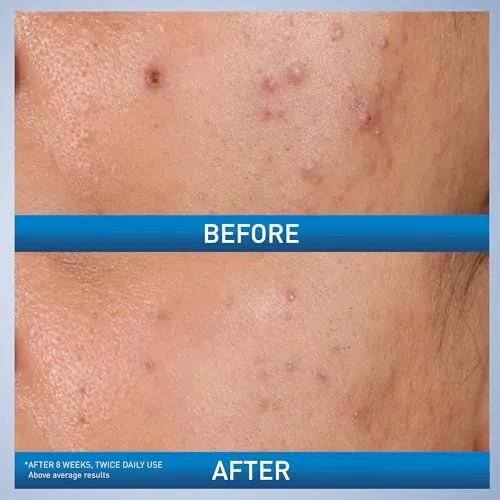 CeraVe Acne Control Gel Review: 2% Salicylic Acid Gel image 2