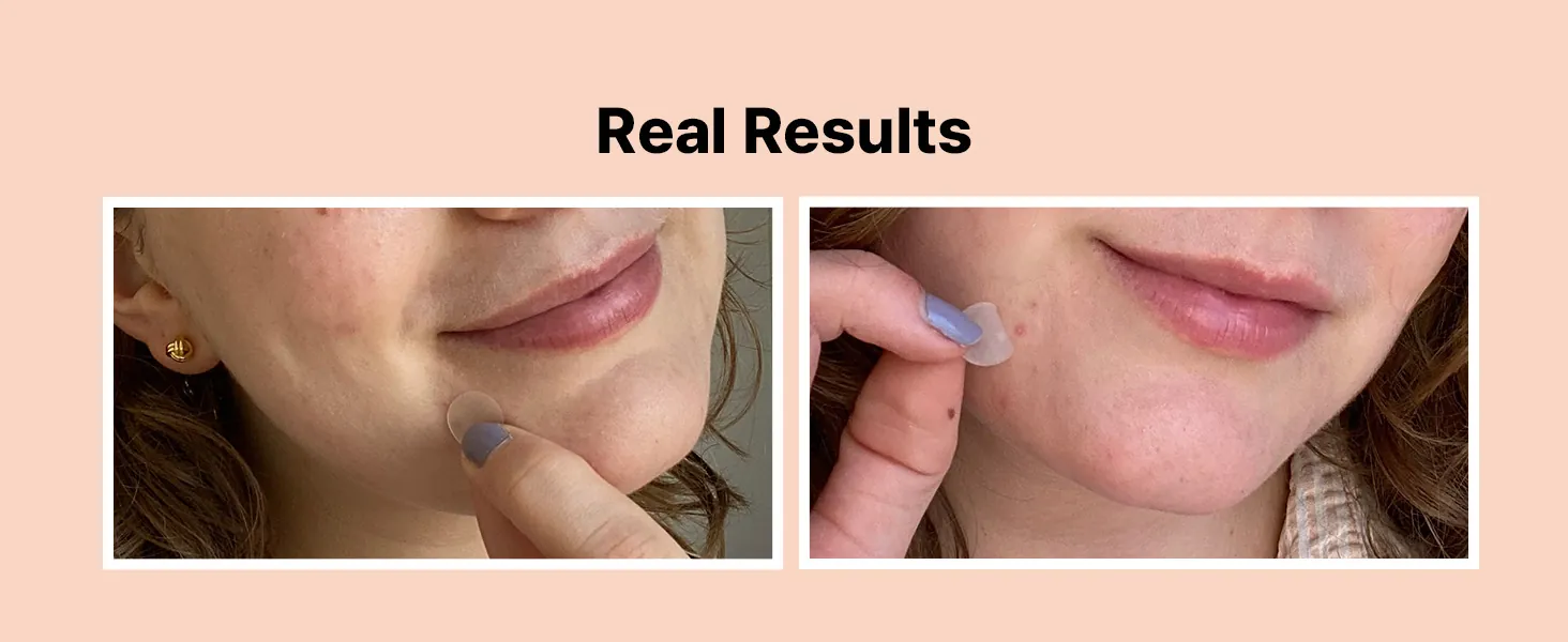 COSRX Acne Pimple Patch Review: Hydrocolloid Spot Patches image 9